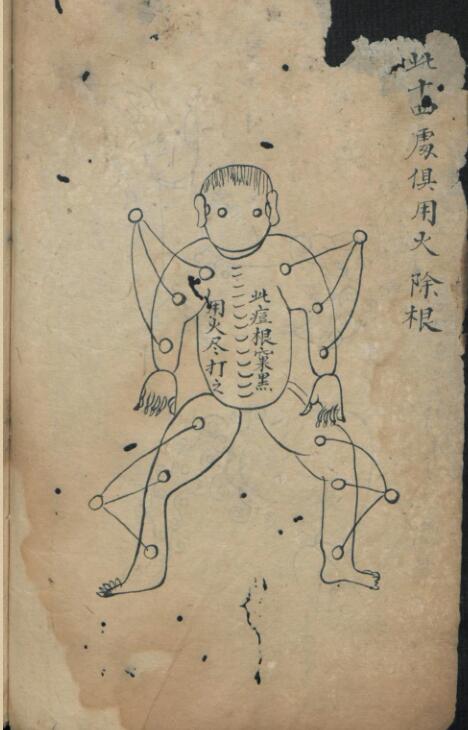 痘疹点烙及诊治